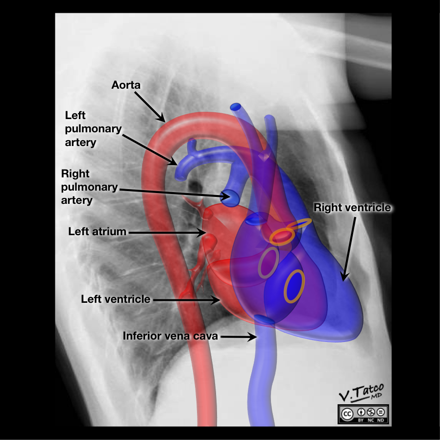 Radiopaedia Drawing/Xray Position of heart and great vessels in